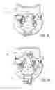 Fig. 02 - CERVICAL COLLAR WITH INDEPENDENT HEIGHT AND CIRCUMFERENCE ADJUSTABILITY