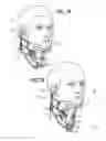 Fig. 07 - CERVICAL COLLAR WITH INDEPENDENT HEIGHT AND CIRCUMFERENCE ADJUSTABILITY