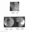 Fig. 26 - Method and devices for flow occlusion during device exchanges