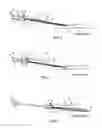 Fig. 03 - Method of indwelling a needle assembly