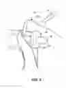 Fig. 06 - Intermittent catheter assembly