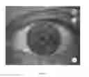 Fig. 12 - Corneal vitrification, methods and devices to produce corneal vitrification and methods of use thereof