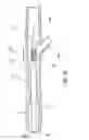 Fig. 06 - PERCUTANEOUS CATHETER-BASED ARTERIAL DENERVATION WITH INTEGRAL EMOBOLIC FILTER