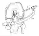 Fig. 01 - Drill pin for fixation of ligaments using button/loop construct
