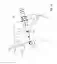 Fig. 02 - Intraocular shunt inserter