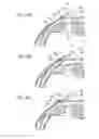 Fig. 28 - Intraocular shunt inserter