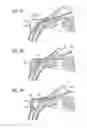 Fig. 31 - Intraocular shunt inserter