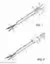 Fig. 07 - Soft tissue coring biopsy devices and methods