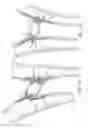 Fig. 08 - MULTI-LAYER BRAIDED STRUCTURES FOR OCCLUDING VASCULAR DEFECTS