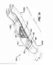 Fig. 10 - Hybrid adjunct materials for use in surgical stapling