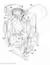 Fig. 01 - Lockable pedicle fastener