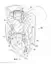 Fig. 04 - Lockable pedicle fastener