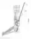 Fig. 06 - Devices and methods for bone fixation using axial implants
