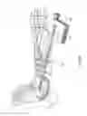 Fig. 09 - Devices and methods for bone fixation using axial implants