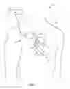 Fig. 02 - Adaptive cardiac resynchronization therapy