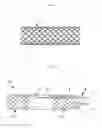 Fig. 02 - STENT FOR ELECTROTHERMAL TREATMENT