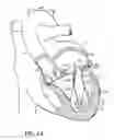 Fig. 02 - Tissue fastening systems and methods utilizing magnetic guidance