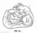 Fig. 06 - Tissue fastening systems and methods utilizing magnetic guidance