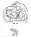 Fig. 08 - Tissue fastening systems and methods utilizing magnetic guidance