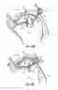 Fig. 32 - Tissue fastening systems and methods utilizing magnetic guidance