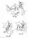 Fig. 37 - Tissue fastening systems and methods utilizing magnetic guidance