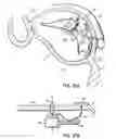 Fig. 44 - Tissue fastening systems and methods utilizing magnetic guidance