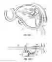 Fig. 46 - Tissue fastening systems and methods utilizing magnetic guidance
