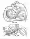 Fig. 48 - Tissue fastening systems and methods utilizing magnetic guidance