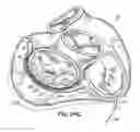 Fig. 49 - Tissue fastening systems and methods utilizing magnetic guidance
