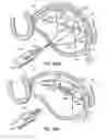 Fig. 71 - Tissue fastening systems and methods utilizing magnetic guidance