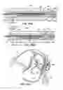 Fig. 72 - Tissue fastening systems and methods utilizing magnetic guidance