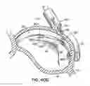 Fig. 74 - Tissue fastening systems and methods utilizing magnetic guidance