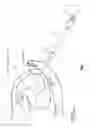 Fig. 07 - METHOD AND APPARATUS FOR REPAIRING A MITRAL VALVE