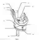 Fig. 02 - SPACER IMPLANT FOR THE TEMPORARY REPLACEMENT OF A KNEE PROSTHESIS
