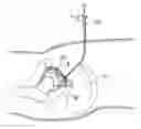 Fig. 01 - Hip joint method