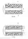 Fig. 08 - Ureteral stents with waveform interlayers and interstitching
