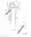 Fig. 07 - Orthopaedic implant and method of installing same