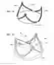 Fig. 31 - Methods of making a durable multi-layer high strength polymer composite suitable for prosthetic valves