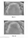 Fig. 22 - Intra-oral light-therapy apparatuses and methods for their use