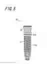 Fig. 06 - DENTAL IMPLANT