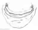 Fig. 01 - COMPONENTS FOR PERMANENT REMOVABLE AND ADJUSTABLE DENTURES AND BRIDGES