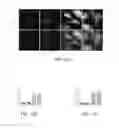 Fig. 11 - STIMULATION OF HUMAN MEIBOMIAN GLAND FUNCTION