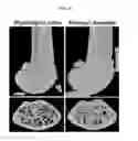 Fig. 06 - Bone loss preventing and bone regeneration or bone formation promoting pharmaceutical composition comprising muramyl dipeptide