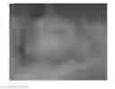 Fig. 01 - Emulsions or microemulsions for use in endoscopic mucosal resectioning and/or endoscopic submucosal dissection