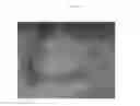 Fig. 02 - Emulsions or microemulsions for use in endoscopic mucosal resectioning and/or endoscopic submucosal dissection