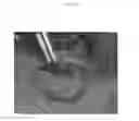 Fig. 07 - Emulsions or microemulsions for use in endoscopic mucosal resectioning and/or endoscopic submucosal dissection