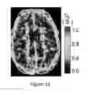 Fig. 12 - High-resolution metabolic neuroimaging