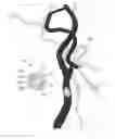 Fig. 01 - Blood vessel sizing device