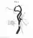 Fig. 03 - Blood vessel sizing device