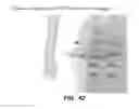 Fig. 35 - Method for providing directional therapy to skeletal joints